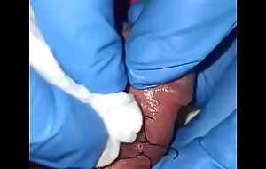 Perlas  en el pene implantacion